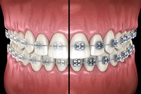 metal brackets vs ceramic|traditional metal braces vs ceramic.